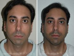 Revision Rhinoplasty Before and After Photos in Miami, FL, Patient 15647