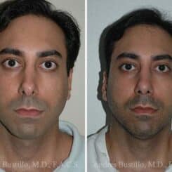 Revision Rhinoplasty Before and After Photos in Miami, FL, Patient 15647