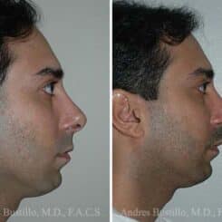 Revision Rhinoplasty Before and After Photos in Miami, FL, Patient 15647