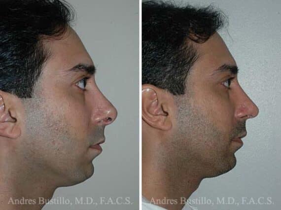 Revision Rhinoplasty Before and After Photos in Miami, FL, Patient 15647