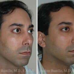 Revision Rhinoplasty Before and After Photos in Miami, FL, Patient 15647