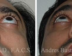 Revision Rhinoplasty Before and After Photos in Miami, FL, Patient 15647