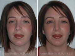 Revision Rhinoplasty Before and After Photos in Miami, FL, Patient 15656