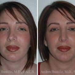 Revision Rhinoplasty Before and After Photos in Miami, FL, Patient 15656