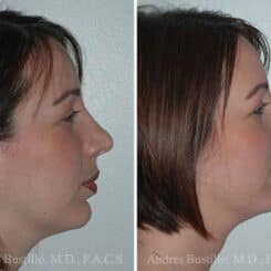 Revision Rhinoplasty Before and After Photos in Miami, FL, Patient 15656