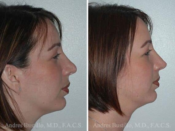 Revision Rhinoplasty Before and After Photos in Miami, FL, Patient 15656