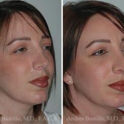 Revision Rhinoplasty Before and After Photos in Miami, FL, Patient 15656