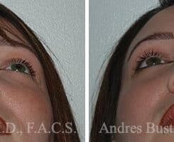 Revision Rhinoplasty Before and After Photos in Miami, FL, Patient 15656