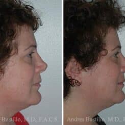 Revision Rhinoplasty Before and After Photos in Miami, FL, Patient 15665