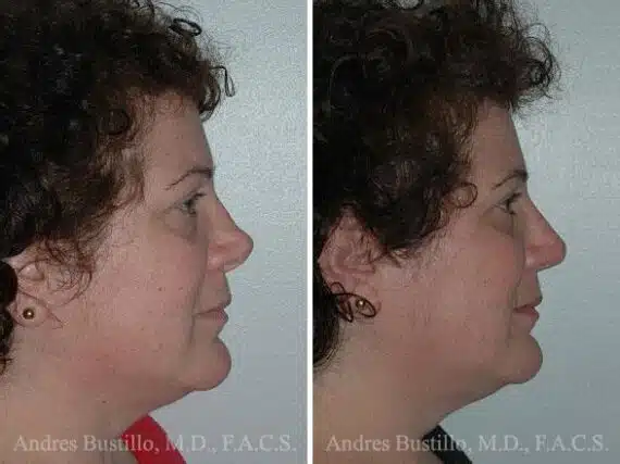 Revision Rhinoplasty Before and After Photos in Miami, FL, Patient 15665