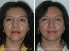 Revision Rhinoplasty Before and After Photos in Miami, FL, Patient 15674