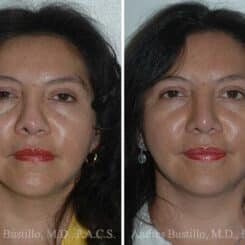 Revision Rhinoplasty Before and After Photos in Miami, FL, Patient 15674