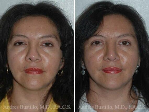 Revision Rhinoplasty Before and After Photos in Miami, FL, Patient 15674