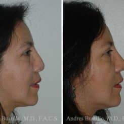 Revision Rhinoplasty Before and After Photos in Miami, FL, Patient 15674