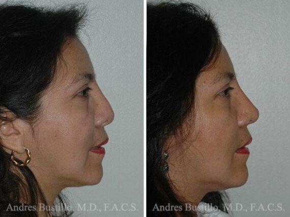 Revision Rhinoplasty Before and After Photos in Miami, FL, Patient 15674