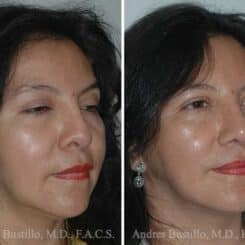 Revision Rhinoplasty Before and After Photos in Miami, FL, Patient 15674