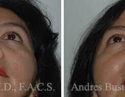 Revision Rhinoplasty Before and After Photos in Miami, FL, Patient 15674