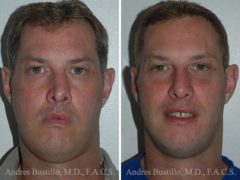 Revision Rhinoplasty Before and After Photos in Miami, FL, Patient 15683