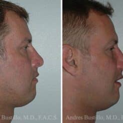 Revision Rhinoplasty Before and After Photos in Miami, FL, Patient 15683