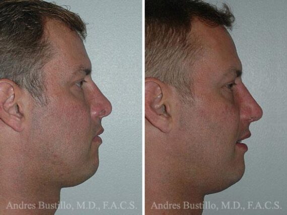 Revision Rhinoplasty Before and After Photos in Miami, FL, Patient 15683