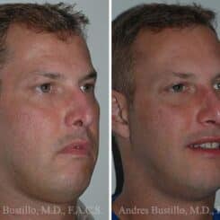 Revision Rhinoplasty Before and After Photos in Miami, FL, Patient 15683