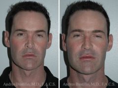 Revision Rhinoplasty Before and After Photos in Miami, FL, Patient 15620