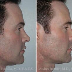 Revision Rhinoplasty Before and After Photos in Miami, FL, Patient 15620