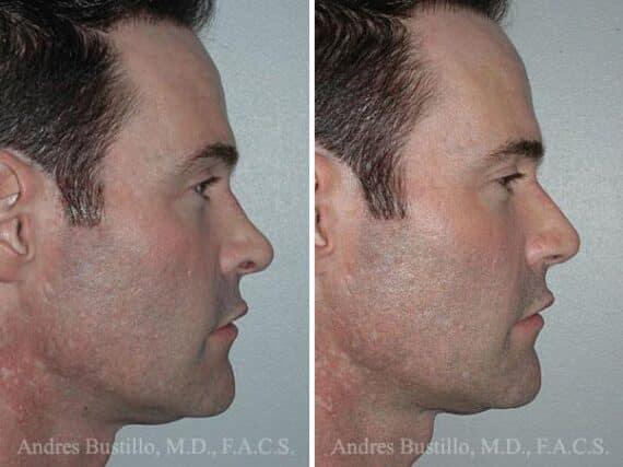 Revision Rhinoplasty Before and After Photos in Miami, FL, Patient 15620