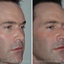 Revision Rhinoplasty Before and After Photos in Miami, FL, Patient 15620