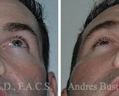 Revision Rhinoplasty Before and After Photos in Miami, FL, Patient 15620