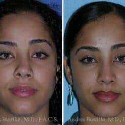 Revision Rhinoplasty Before and After Photos in Miami, FL, Patient 15629