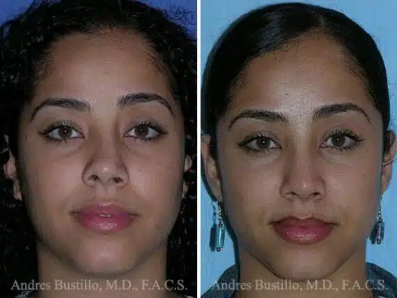 Revision Rhinoplasty Before and After Photos in Miami, FL, Patient 15629