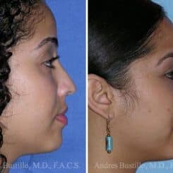 Revision Rhinoplasty Before and After Photos in Miami, FL, Patient 15629