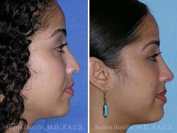 Revision Rhinoplasty Before and After Photos in Miami, FL, Patient 15629