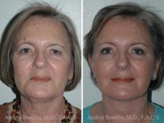 Deep Plane Facelift Before and After Photos in Miami, FL, Patient 15692