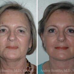 Deep Plane Facelift Before and After Photos in Miami, FL, Patient 15692