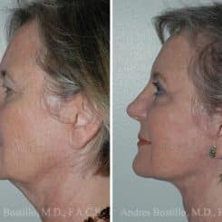 Deep Plane Facelift Before and After Photos in Miami, FL, Patient 15692