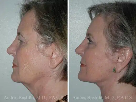 Deep Plane Facelift Before and After Photos in Miami, FL, Patient 15692