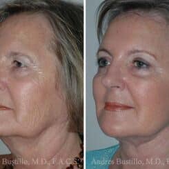 Deep Plane Facelift Before and After Photos in Miami, FL, Patient 15692