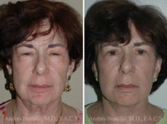 Deep Plane Facelift Before and After Photos in Miami, FL, Patient 15706