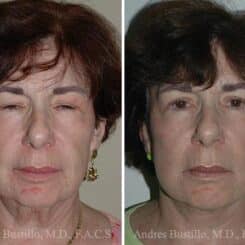 Deep Plane Facelift Before and After Photos in Miami, FL, Patient 15706