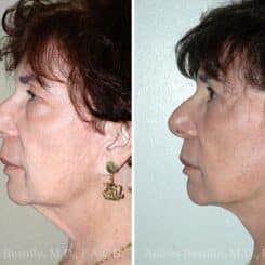 Deep Plane Facelift Before and After Photos in Miami, FL, Patient 15706