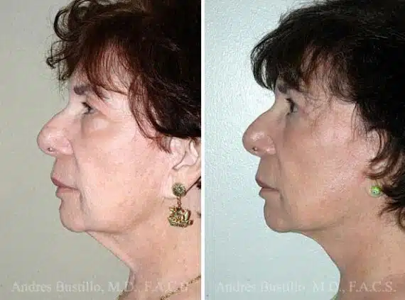 Deep Plane Facelift Before and After Photos in Miami, FL, Patient 15706