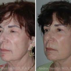 Deep Plane Facelift Before and After Photos in Miami, FL, Patient 15706
