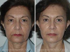 Deep Plane Facelift Before and After Photos in Miami, FL, Patient 15720