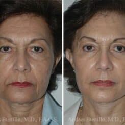 Deep Plane Facelift Before and After Photos in Miami, FL, Patient 15720