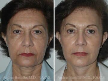 Deep Plane Facelift Before and After Photos in Miami, FL, Patient 15720