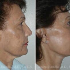 Deep Plane Facelift Before and After Photos in Miami, FL, Patient 15720