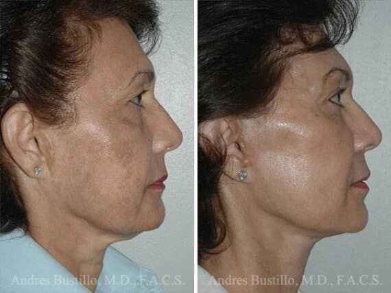 Deep Plane Facelift Before and After Photos in Miami, FL, Patient 15720