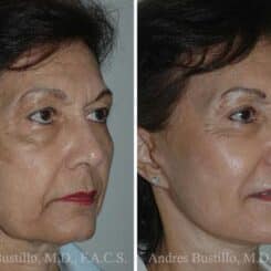 Deep Plane Facelift Before and After Photos in Miami, FL, Patient 15720